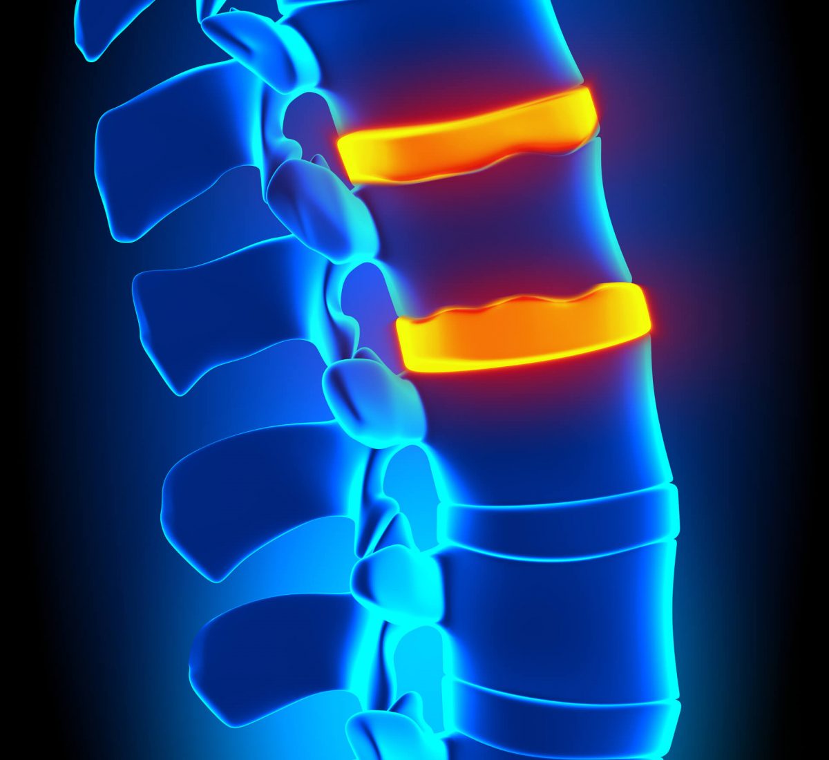 What is the difference between a slipped disc, bulging disc, herniated
